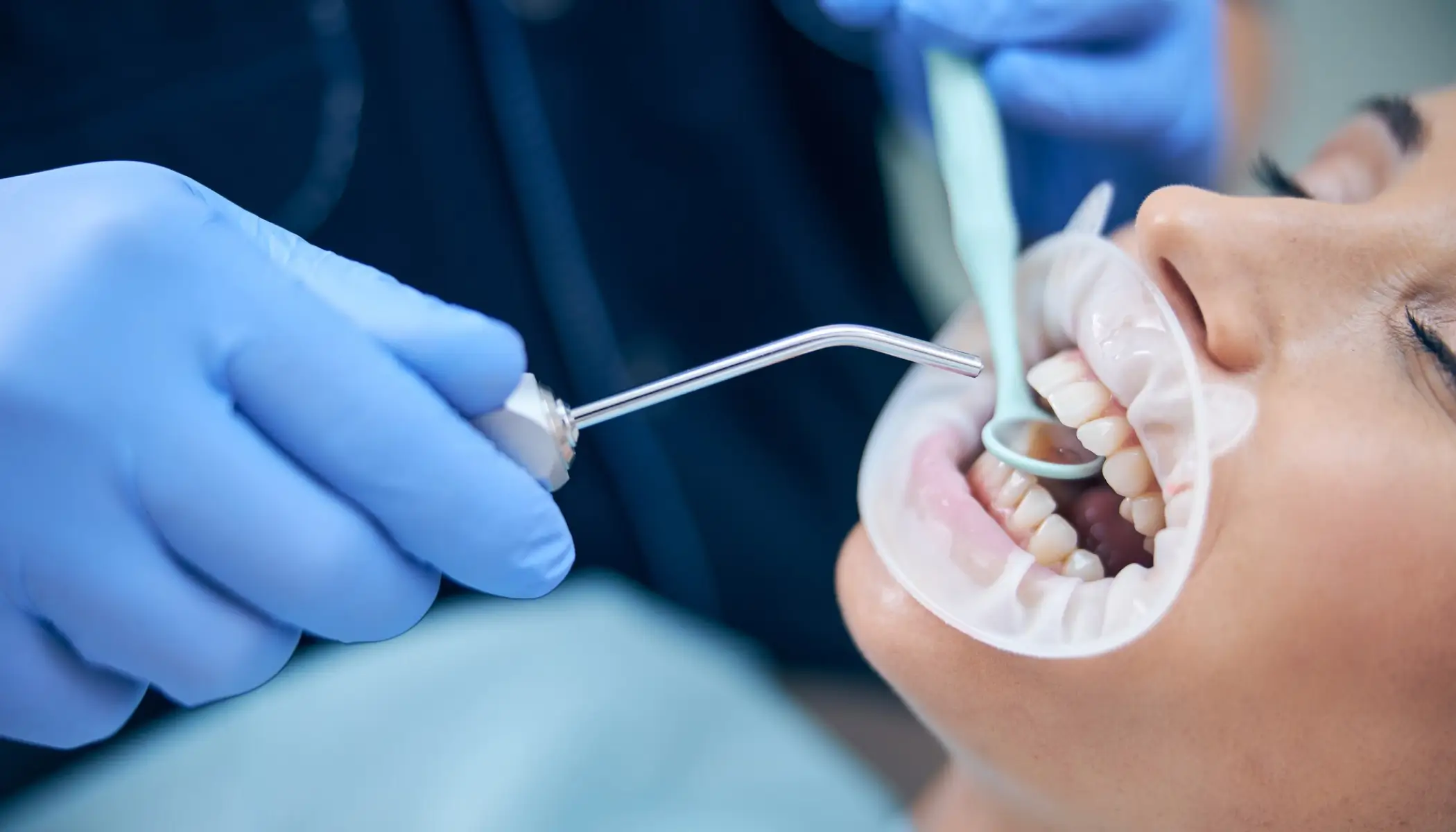 dental veneers