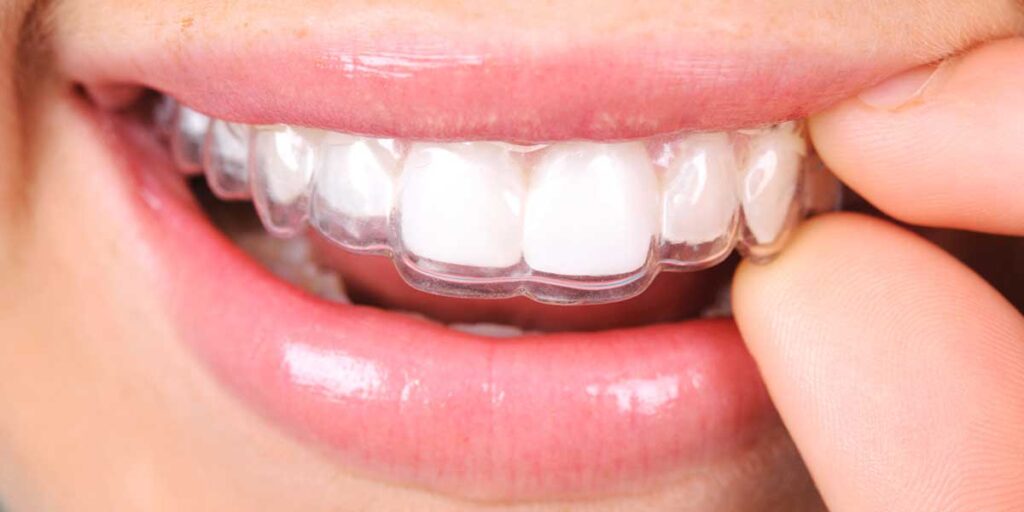 Clear Aligners