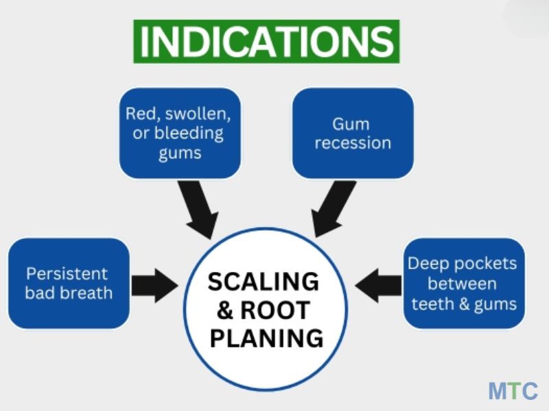 Scaling-and-Root-Planing-burleson