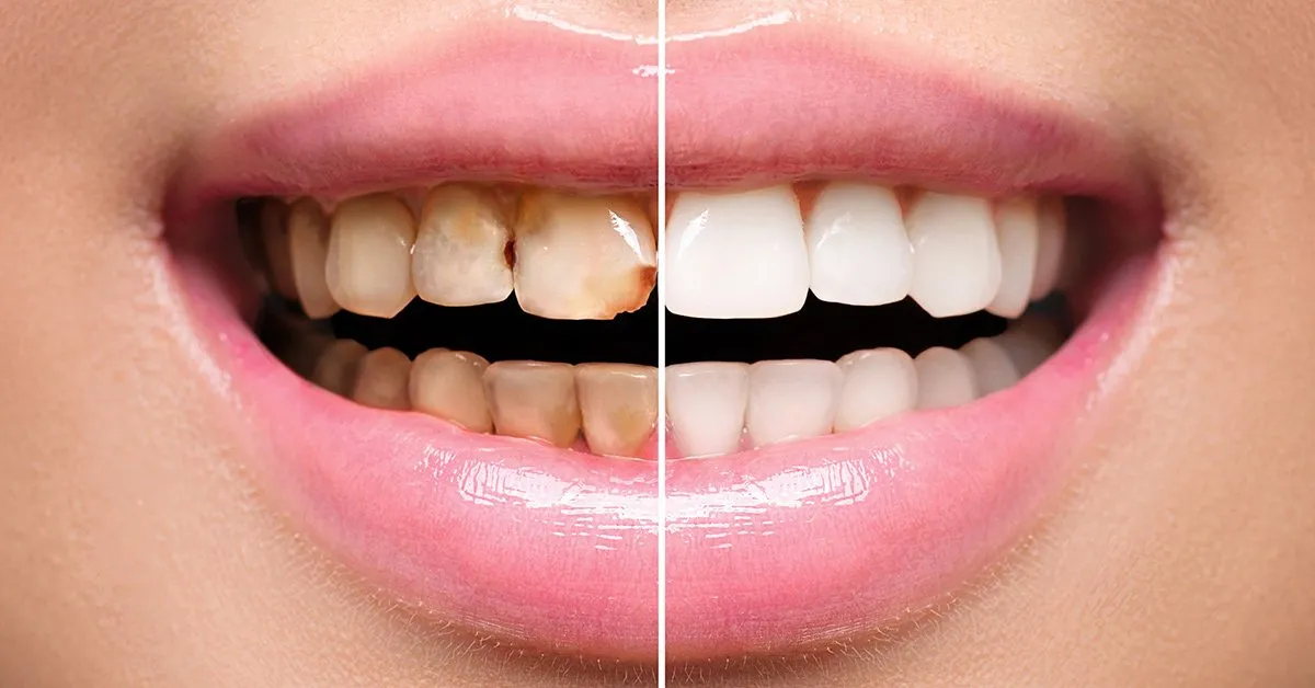 Clear Aligners