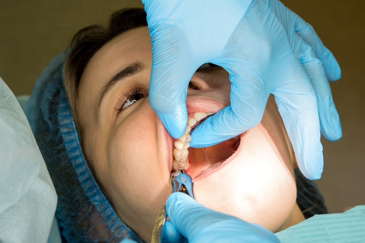 Tooth_Bridges_burleson_dental