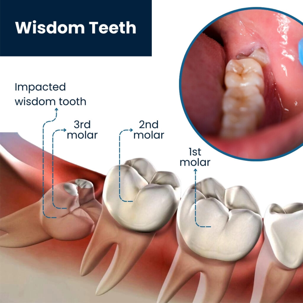 wisdom-teeth_burleson_dental